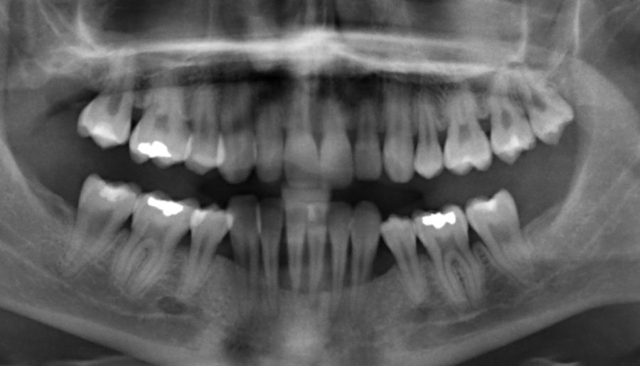 Das parodontale Ehlers-Danlos Syndrom