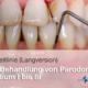 S3-Leitlinien | Die Behandlung von Parodontitis Stadium I bis III